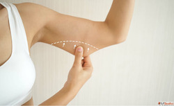 What You Need to Know About Arm Lift Surgery