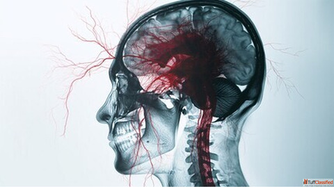 Brain Aneurysm Surgeons in Kerala