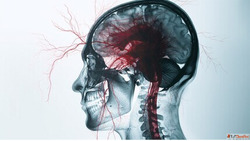 Brain Aneurysm Surgeons in Kerala