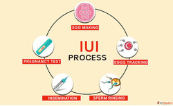 IUI Treatment Cost in Delhi - Dr Rhythm Gupta