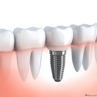 Dental Implants in Duabi