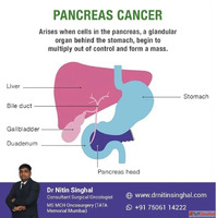 Pancreatic Cancer Treatment in Ahmedabad India Smart Approac...