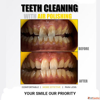 Brighten Your Smile with Professional Teeth Whitening