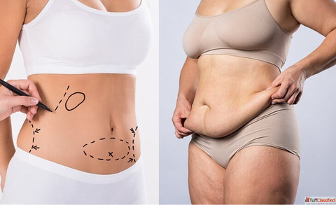 Tummy Tuck Surgery cost in Delhi - Dr Rajat Gupta