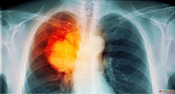 Get Expert Lung Cancer Treatment in Agra with Quality Care