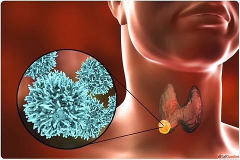 Thyroid Cancer in Women Key Symptoms Every Female Must Know
