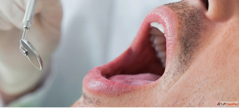 Homeopathic Treatment for Mouth Cancer Safe Supportive Care