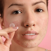 Acne Treatment