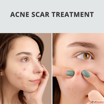 Targeted Acne Scar Treatment in Andheri West Restore Clearer Skin with Confidence