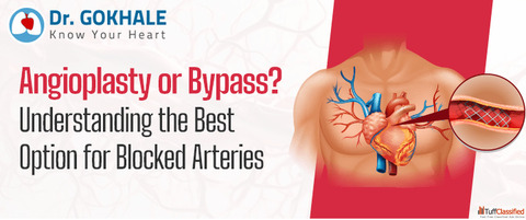 Angioplasty vs Bypass Best Treatment for Blocked Arteries