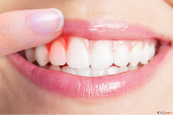 Affordable Dental Implant in Delhi NCR
