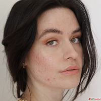 Acne Treatment in Oman