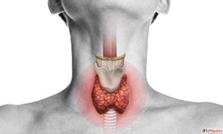 Thyroid Relief in Agra with Homeopathy by Dr. Ankur Prakash