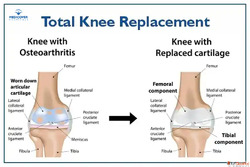 Top Orthopedic Surgeon for Knee Replacement in Hyderabad Med...