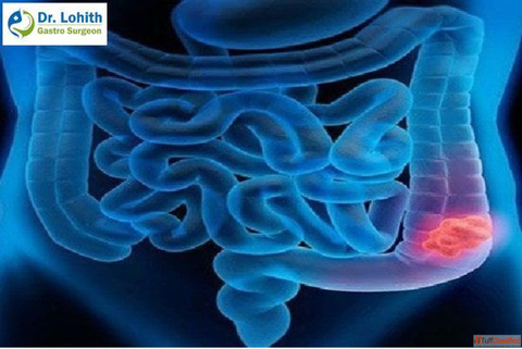 Expert Colon Cancer Treatment in Sarjapur Road