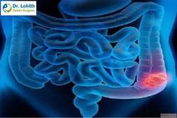 Expert Colon Cancer Treatment in Sarjapur Road