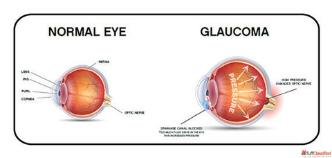 Experienced The Best Glaucoma Specialist in Bardhaman