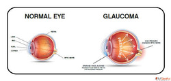 Experienced The Best Glaucoma Specialist in Bardhaman
