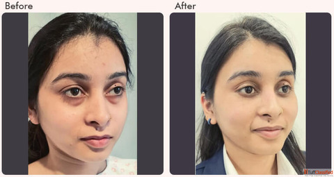 What is Single Eyelid or Double Eyelid Surgery