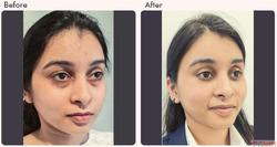 What is Single Eyelid or Double Eyelid Surgery