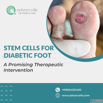 Stem Cells For Diabetic Foot A Promising Therapeutic Intervention