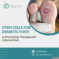 Stem Cells For Diabetic Foot A Promising Therapeutic Interve...