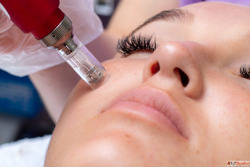 Microneedling Treatment in Kingston Ontario