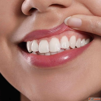 Gum Contouring in Dubai