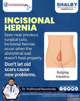Incisional Hernia Treatment in Indore Dr. Muffazzal Rassiwal...