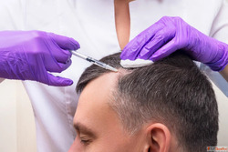 Best Hair Transplant Clinic in Surat Elegance Clinic