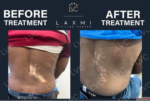 Best Doctor Best Homeopathic Vitiligo Treatment and Packs.