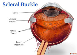 Best Eye Doctors in Indore for Scleral Buckle Surgery - Book...