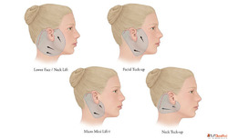 Find Your Youthful Face with Facelift Surgery by Dr. Lokesh ...