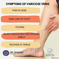 Varicose veins treatment in Mumbai India