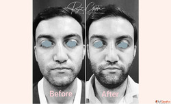 What Are Rhinoplasty Grafts and Why Are They Important