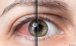 How to Protect Your Eyes from UV Damage