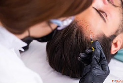 Searching for Hair Transplant Experts in Gorakhpur