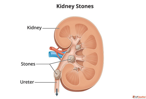 Trusted Homeopathy Doctor in Noida for Kidney Stone Relief