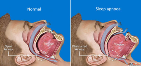 Snoring Treatment Doctors in India