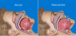 Snoring Treatment Doctors in India