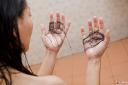 Can Dandruff Be the Reason Behind Your Hair Fall