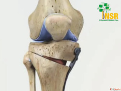 Best knee surgeon in ChennaiNSR Orthopaedic Wellness Center