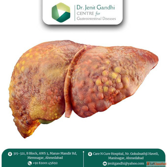 Expert Surgeon for Best Liver Cancer Treatment in Ahmedabad India