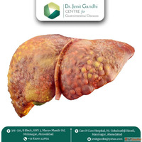 Expert Surgeon for Best Liver Cancer Treatment in Ahmedabad ...