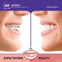 Braces Cost in Pune - Metal Ceramic Invisalign Prices