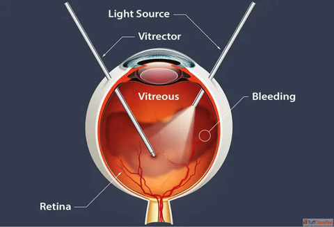 How Long Does It Take to Recover from Retina Surgery