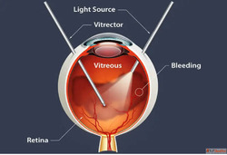 How Long Does It Take to Recover from Retina Surgery