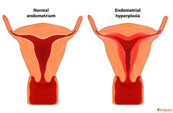 Normal Endometrial Thickness for Pregnancy Endometrium Norma...