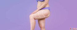 What Is a Thigh Lift Surgery