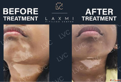 Effective Vitiligo Leucoderma Cure Authentic Homeopathy in M...